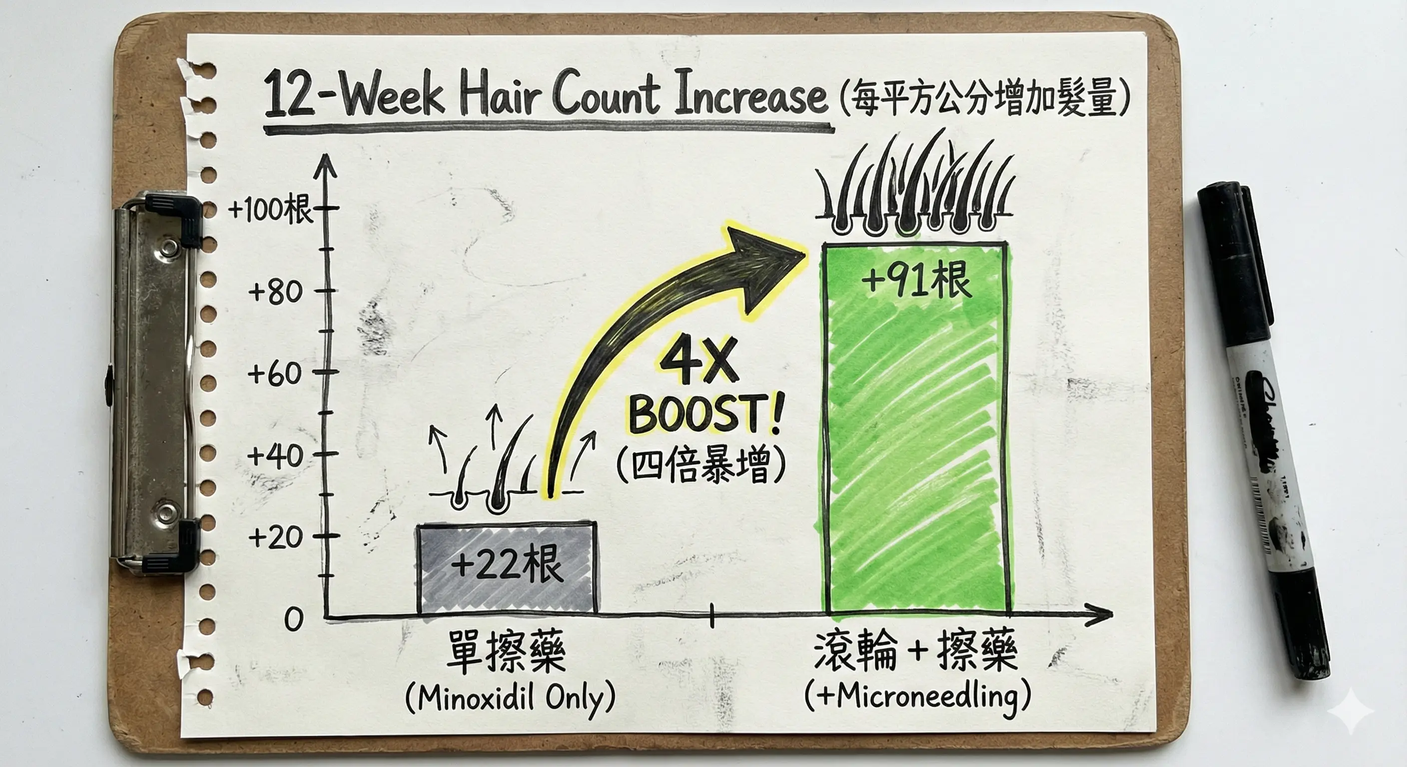 RK 的微針實測數據圖表：長條圖對比顯示單擦生髮水增加 22 根頭髮，而微針加生髮水組增加 91 根，視覺化呈現 4 倍的顯著差距